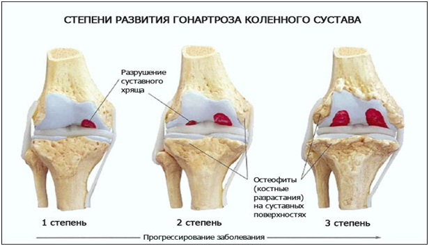 Степени гонартроза коленного сустава