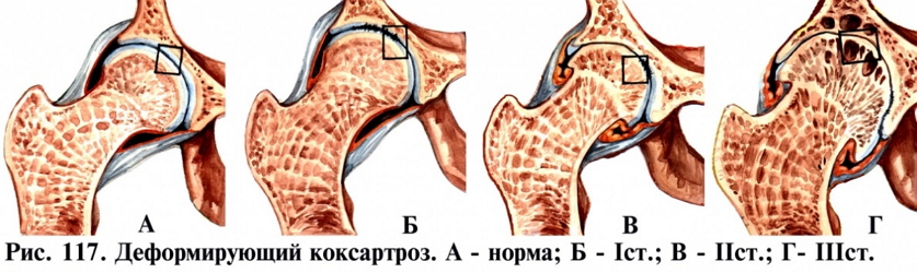 степени коксартроза