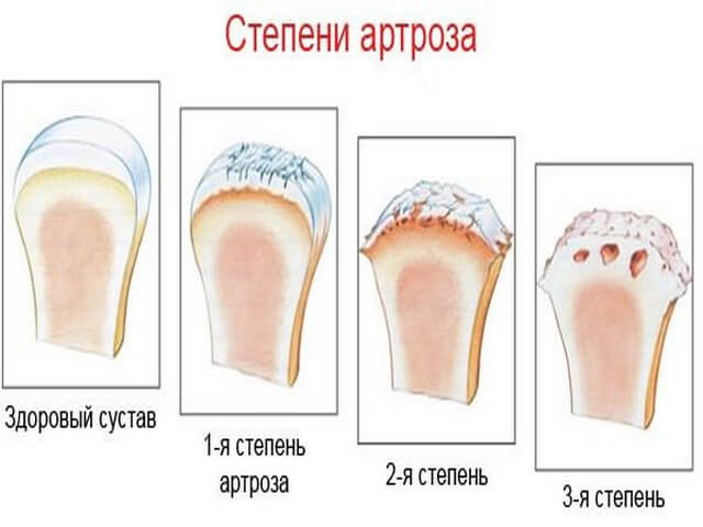 Степени плечевого артроза
