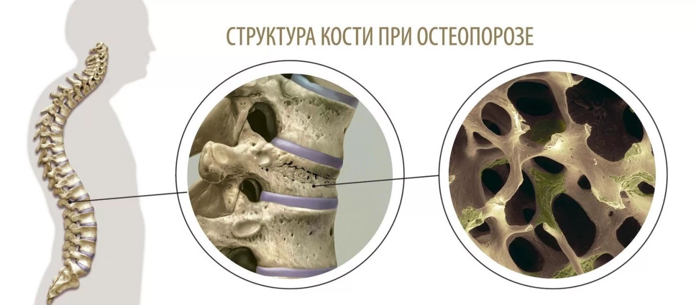структура кости при остеопорозе