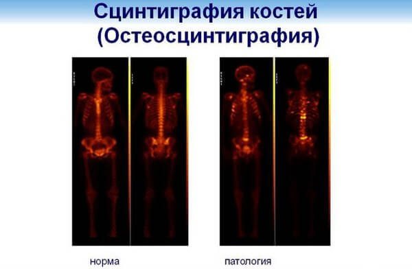 сцинтиграфия