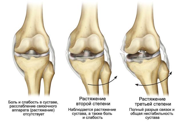 Связки в коленном суставе