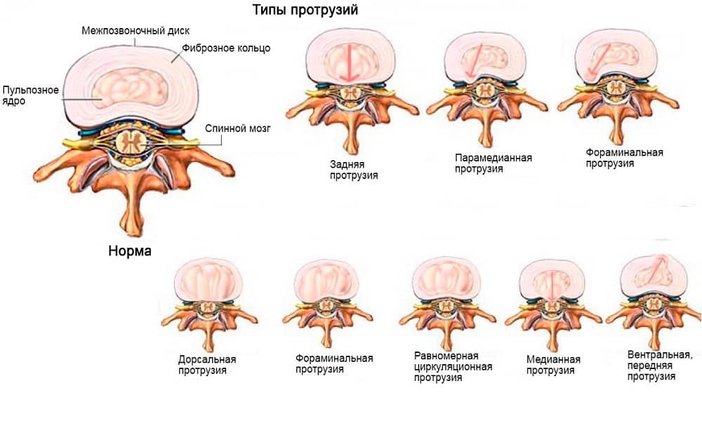 Типы протрузий