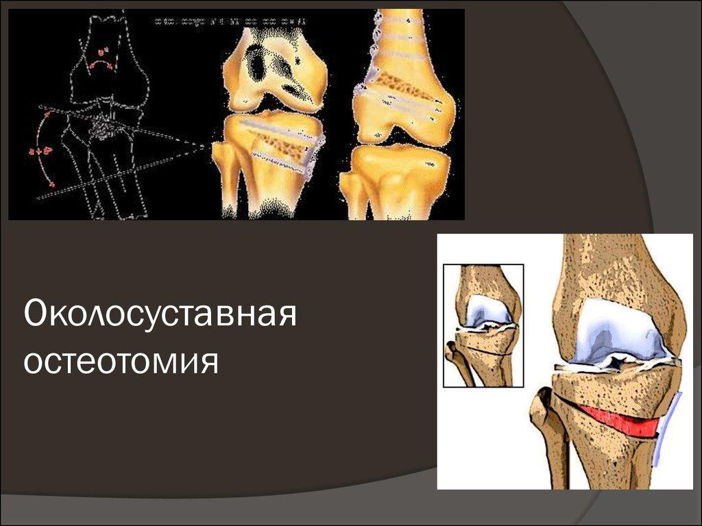 Устранение деформации сустава