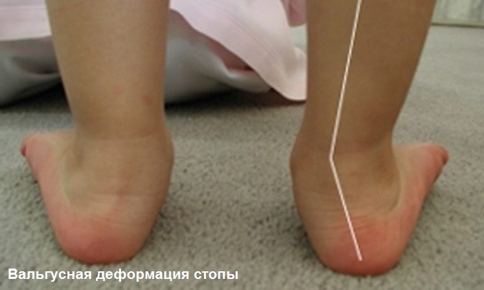 вальгусная нога