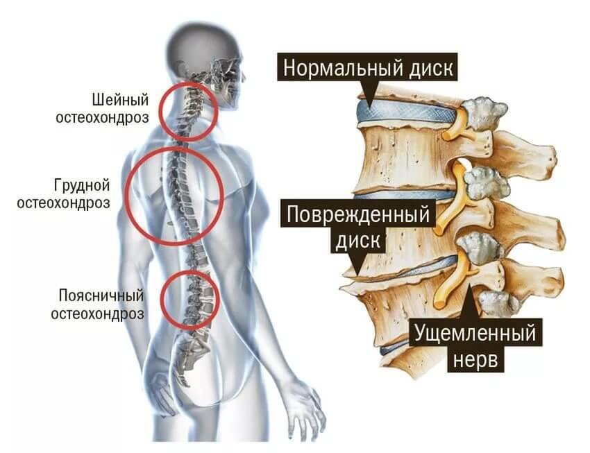 Виды остеохондроза