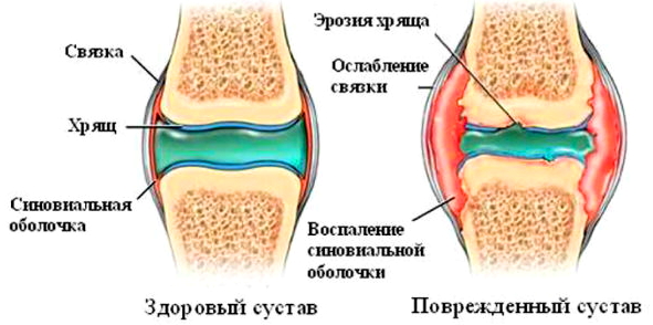 Признаки воспаления синовиальной оболочки