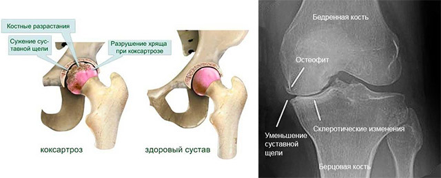 Вторая стадия артроза