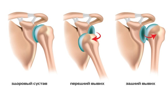 Вывих и подвывих плеча
