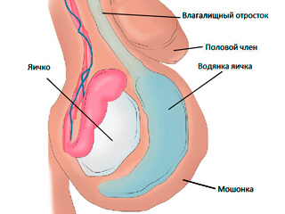 Как выглядит водянка яичка