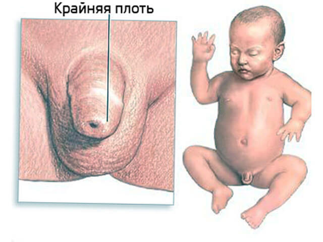 Физиологический фимоз у детей
