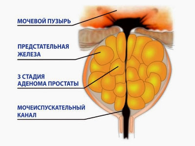 Вторая стадия развития аденомы предстательной железы