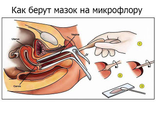 Мазок на флору у женщин для чего берется