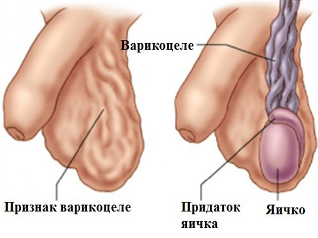 Варикоцеле влияет на бесплодие у мужчин