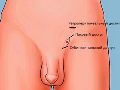 Виды операции варикоцеле