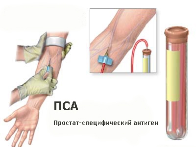 ПСА при раке предстательной железы