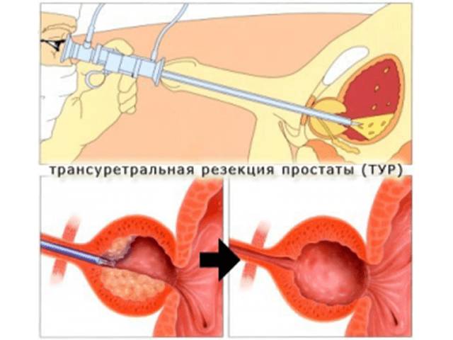 ТУР или удаление аденомы простаты через мочеиспускательный канал и ее последствия