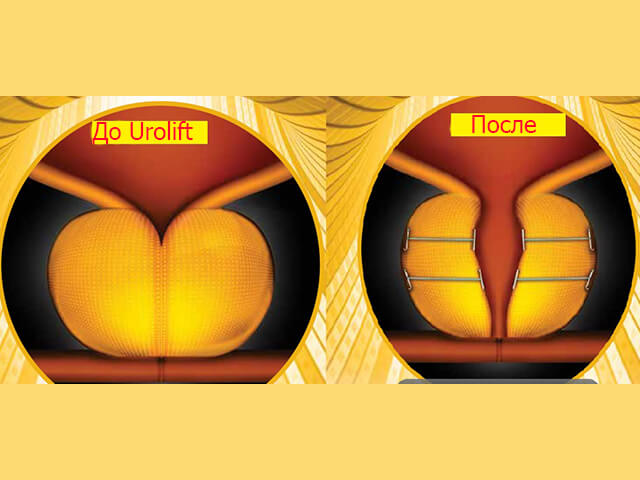 Новые современные способы лечения аденомы простаты Urolift