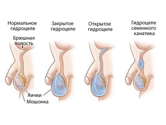 Как выглядит водянка яичка