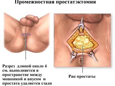Как проводится простатэктомия