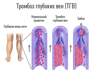 Тромбоз ног - одно из возможных осложнений