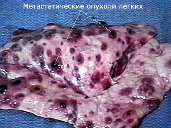 Метастазы в легких при раке простаты