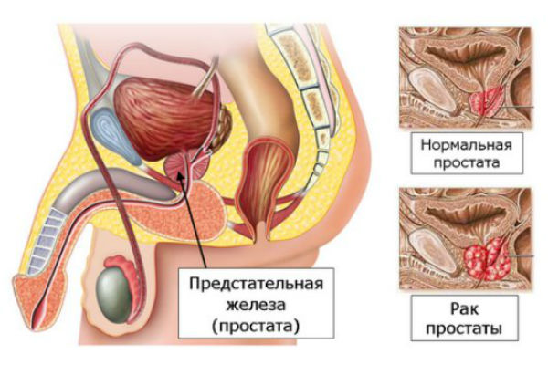Основные симптомы и признаки рака предстательной железы