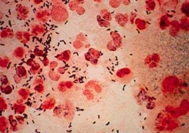 Neisseria gonorrhoeae