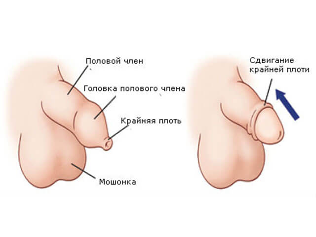 Как лечить фимоз - узкую крайнюю плоть
