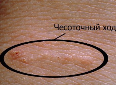 Мазь против чесотки
