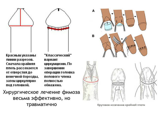 Хирургическое рассечение крайней плоти
