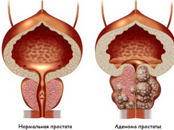 Здоровая простата и аденома простаты
