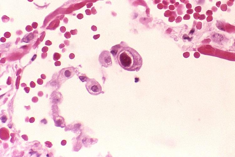 Human betaherpesvirus 5