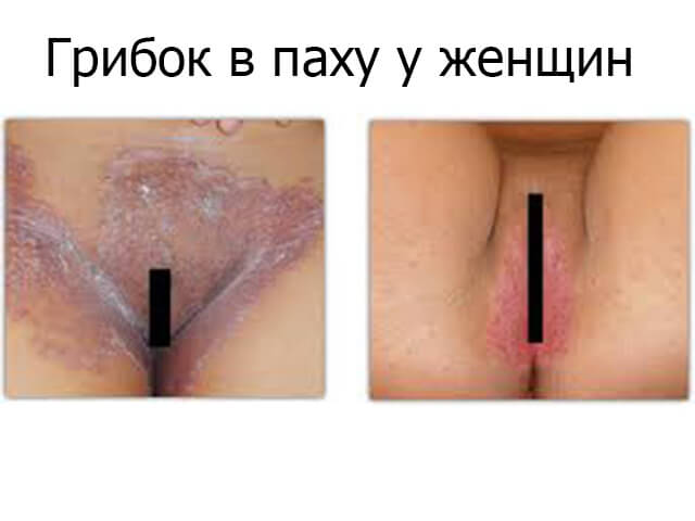 Как выглядит покраснение в паху у женщин