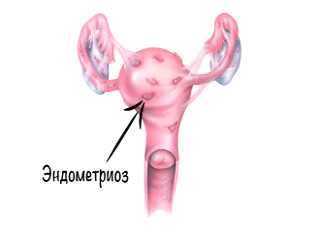 Как лечат эндометриоз