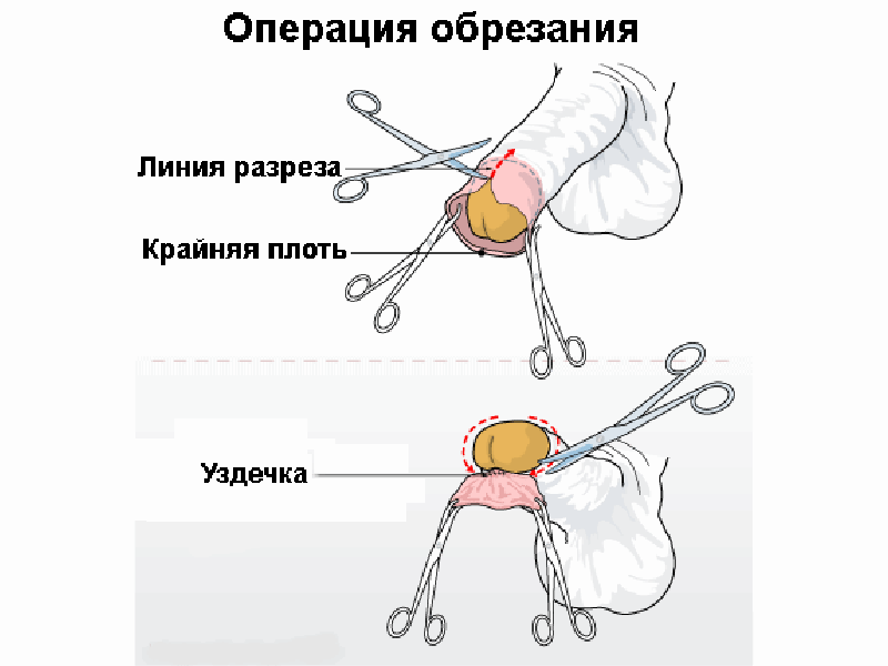 Как проводится обрезание у евреев