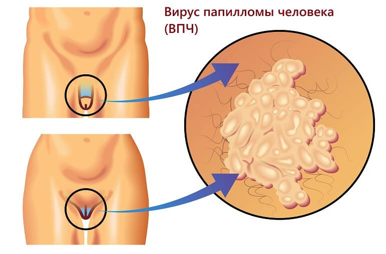Кондиломы на головке