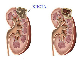 Киста почек