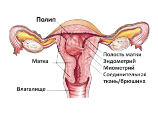 Полип в матке