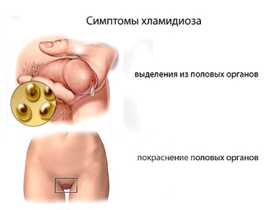 Хламидиоз симптомы