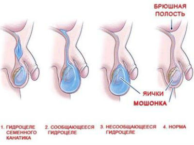 Признаки и симптомы водянки яичка у взрослых