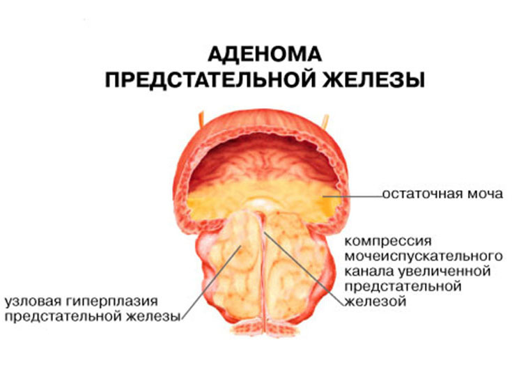 Нужна профилактика чтобы избежать аденомы простаты