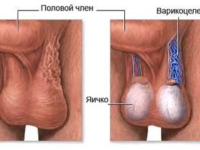Варикоцеле слева: как выглядит