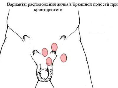 Крипторхизм у детей