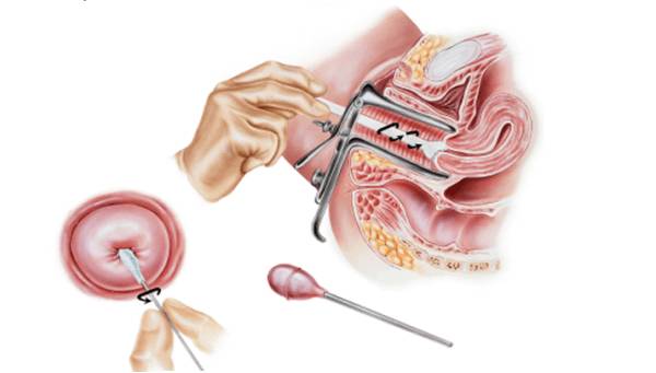 Мазок на онкоцитологию что это такое