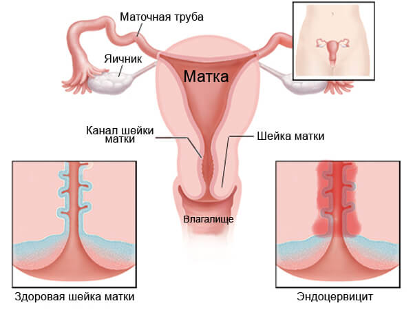 Эндоцервицит - одно из последствий уреаплазмоза у женщин