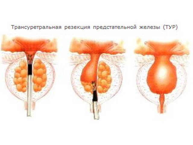 Операция на аденоме простаты и основное послеоперационное лечение
