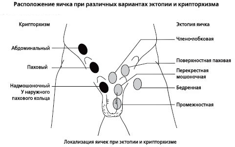 Различные формы крипторхизма