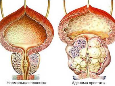Как выглядит аденома простаты