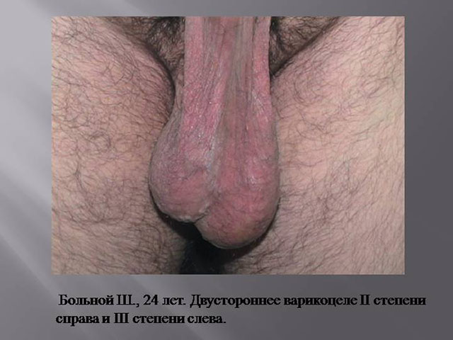 Варикоцеле 2 степени и его фото